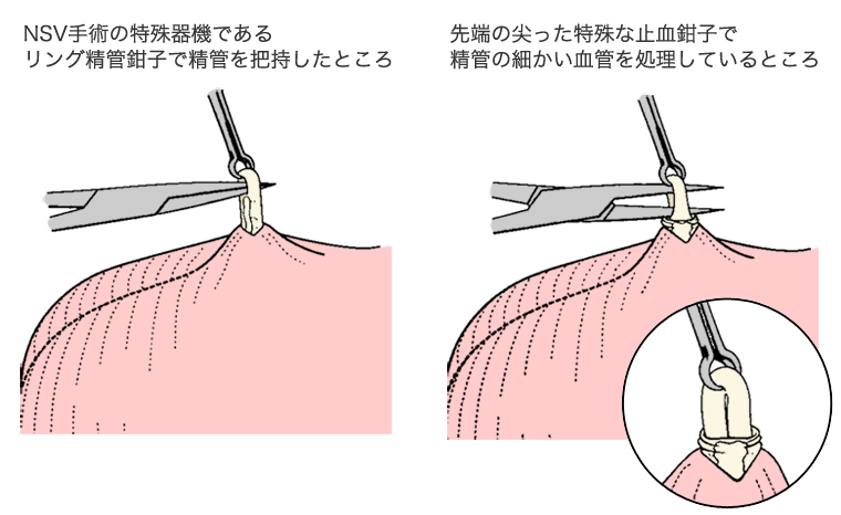 パイプカット手術について Nsv法 銀座muクリニック 東京都 銀座駅 メスを使わないパイプカット手術 Ed治療